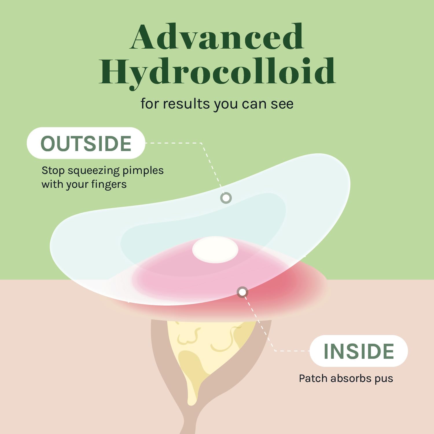 AOA Studio 84-count Hydrocolloid Acne Patches, Vegan, Cruelty-Free, 10mm, 12mm Sizes, Spot Treatment for Blemishes and Acne