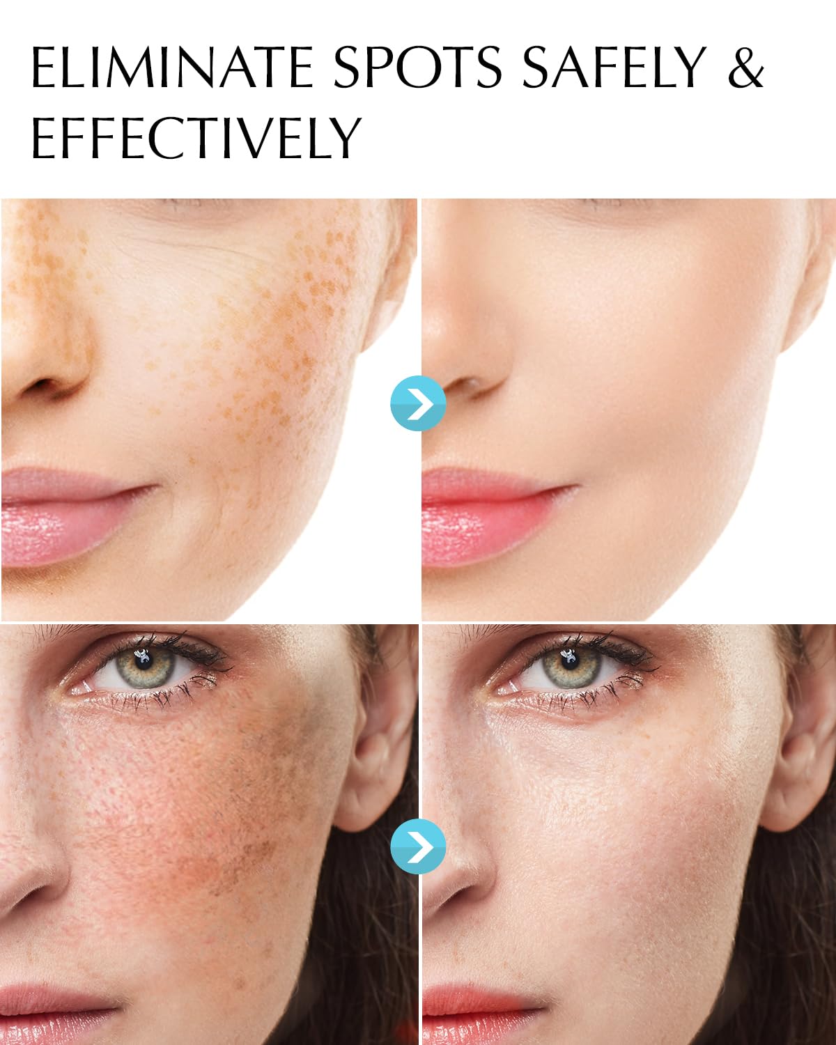 dark-spot-remover-for-face-and-body-hyperpigmentation-treatment-natural-ingredient-melasma-sun-spot-remover