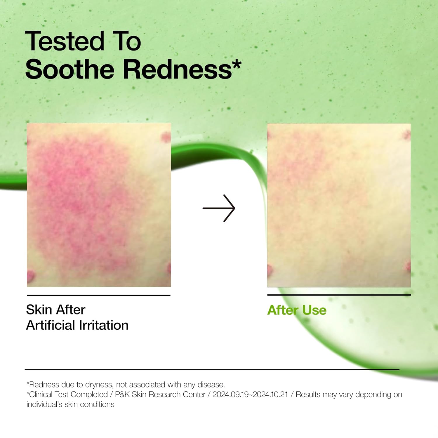 anua azelaic acid 10 hyaluron redness soothing serum for sensitive skin, korean skincare, vegan, 30ml, 1.01 fl oz.