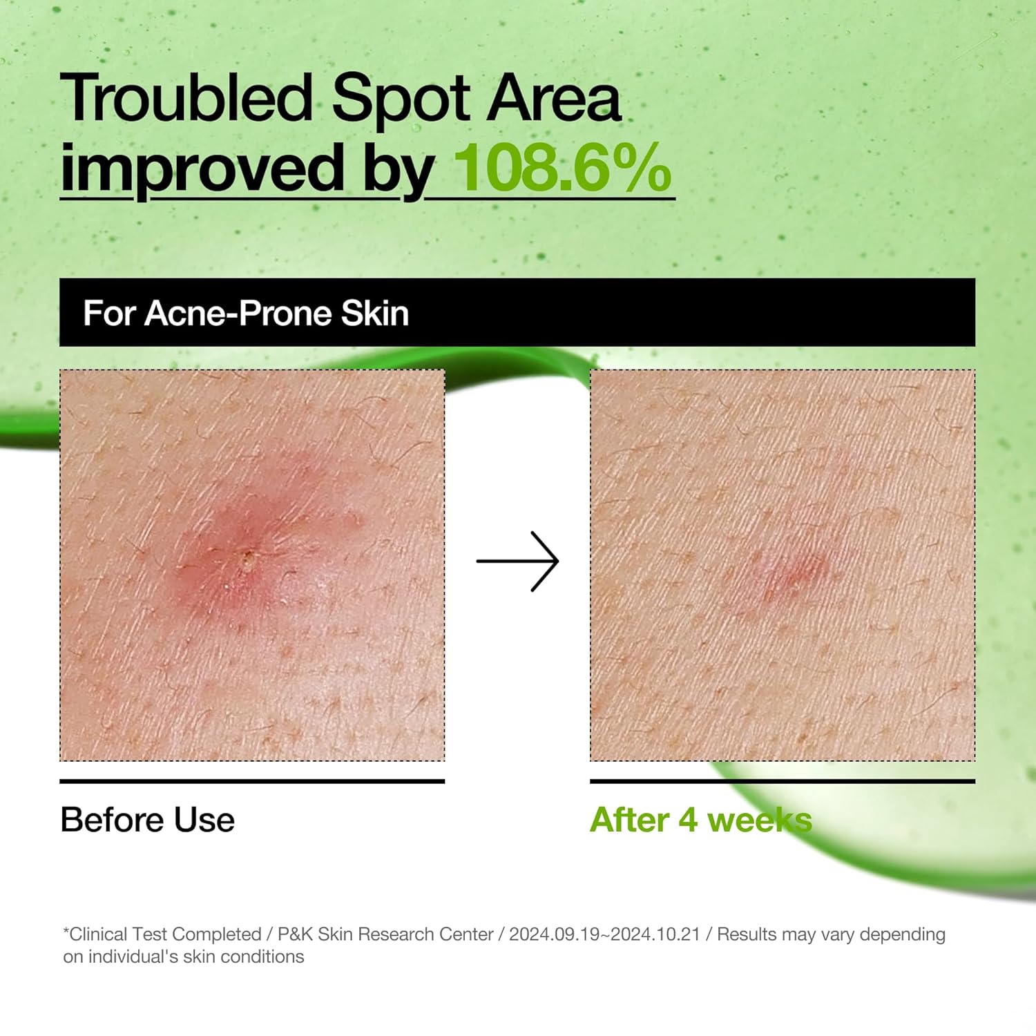 anua azelaic acid 10 hyaluron redness soothing serum for sensitive skin, korean skincare, vegan, 30ml, 1.01 fl oz.