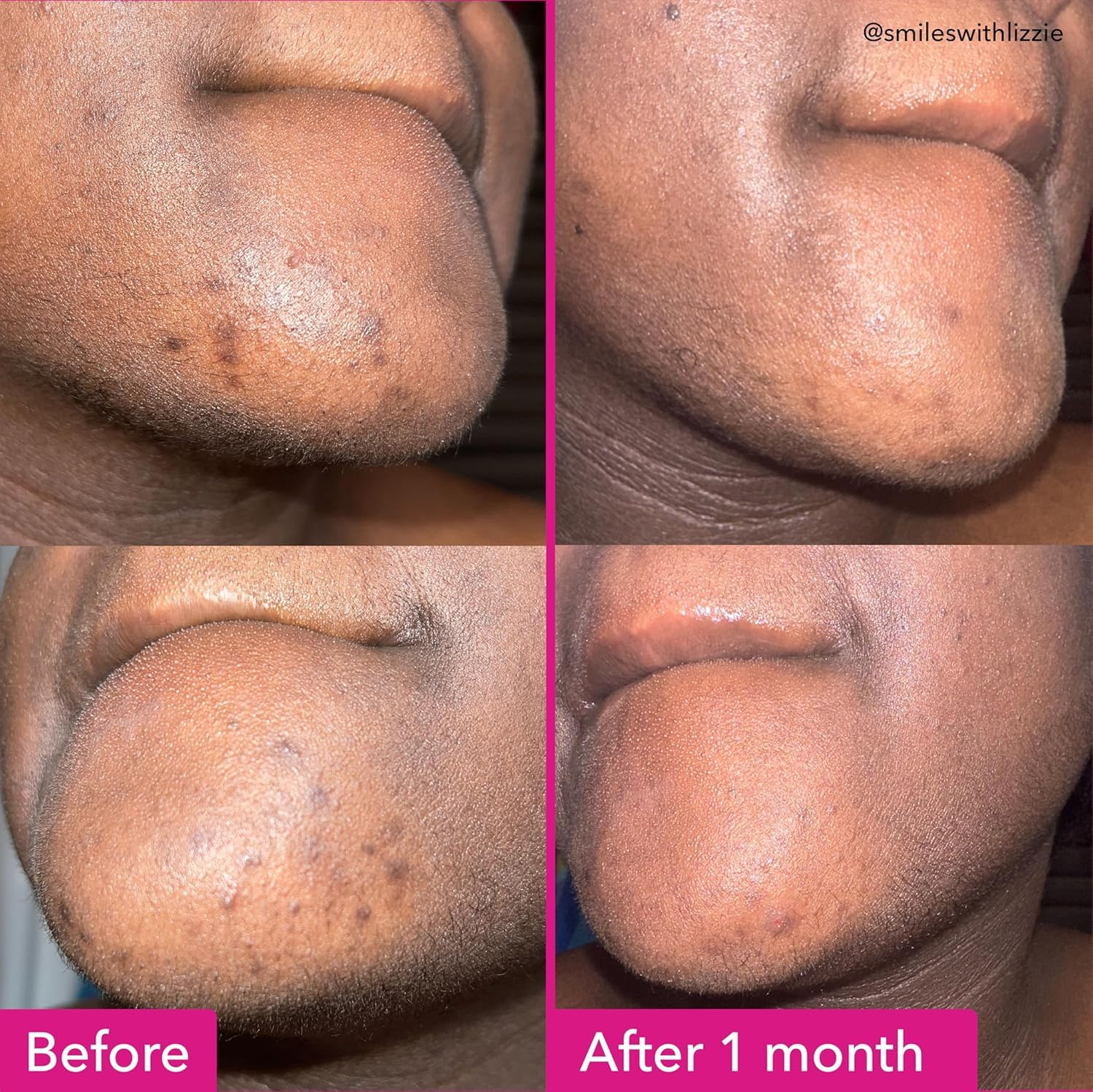 Good Molecules brightening soap free face and body bar with tranexamic kojic acids and niacinamide for dark spots skin care